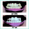 Before-and-after-2-AP-24- Whitening-Flouride -Toothpaste - Quarterly Affair